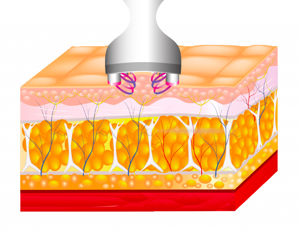 Fat Reduction Body Contouring How It Works Step 2